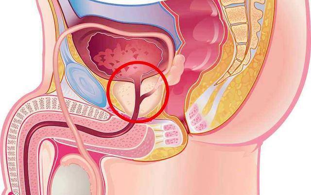 男性前列腺肥大，了解、識(shí)別與應(yīng)對(duì)，男性前列腺肥大，全面解析與應(yīng)對(duì)之道