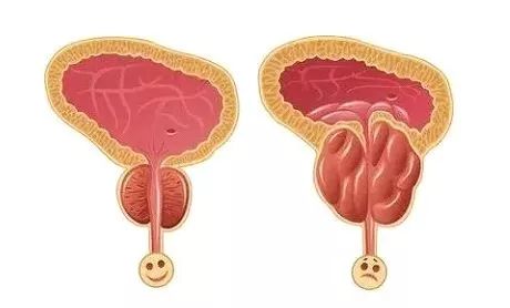 老公的前列腺增大挑戰(zhàn)，理解、支持與共同對(duì)抗，老公前列腺增大，理解、支持與共同應(yīng)對(duì)的挑戰(zhàn)
