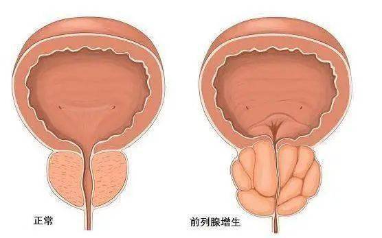 前列腺鈣化，一種常見的前列腺疾病及其相關(guān)知識解析，前列腺鈣化解析，常見疾病與相關(guān)知識探討