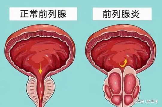 男性前列腺炎的癥狀解析，男性前列腺炎的癥狀詳解