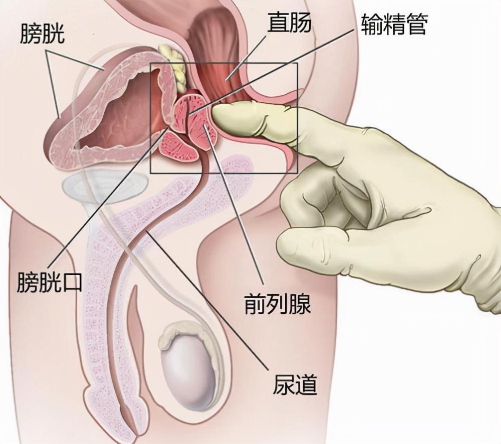 前列腺炎，重新認(rèn)識男性健康的誤區(qū)，重新認(rèn)識男性健康誤區(qū)，前列腺炎解析