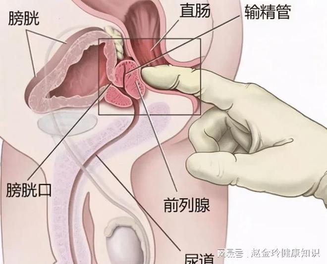 慢性前列腺炎，能否徹底治愈？解析與探討，慢性前列腺炎的治愈可能性解析與探討