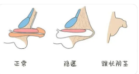 關(guān)于做包皮手術(shù)的費用分析，包皮手術(shù)費用詳解