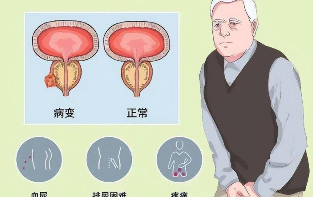 年輕人得了前列腺增大，理解、應對與關注，年輕人前列腺增大，理解、應對與關注的重要性