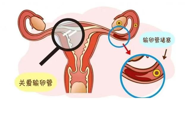 輸卵管堵塞的癥狀表現(xiàn)與解析，輸卵管堵塞的癥狀、表現(xiàn)與解析