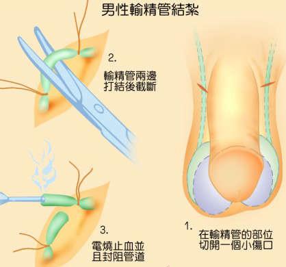 為什么醫(yī)院不提倡男性結(jié)扎，探究背后的原因與考量，探究醫(yī)院不提倡男性結(jié)扎的背后原因與考量