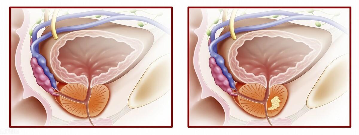 前列腺鈣化，揭示其潛在危害，前列腺鈣化，潛在危害揭秘