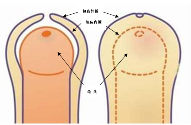 包莖及其相關(guān)圖片，了解、識別與處理，包莖詳解，圖片、識別、處理方法全攻略