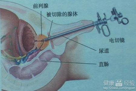 如何控制前列腺增生，如何控制前列腺增生的發(fā)展及癥狀？