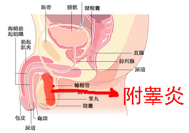 附睪炎，絕望中的希望曙光，附睪炎，絕望中的希望之光